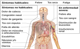 sintomas coronavirus